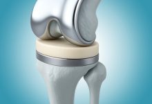 Os principais mitos sobre a prótese de joelho que ainda assustam pacientes