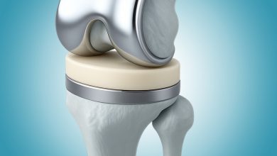 Os principais mitos sobre a prótese de joelho que ainda assustam pacientes