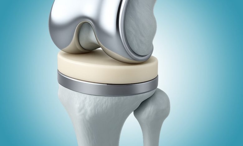 Os principais mitos sobre a prótese de joelho que ainda assustam pacientes